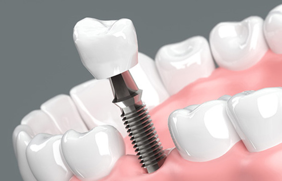 インプラント治療の相場は？費用、寿命、メリット・デメリットを徹底解説