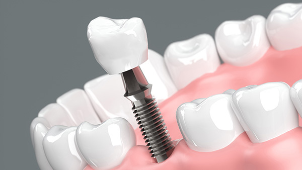 インプラント治療の相場は？費用、寿命、メリット・デメリットを徹底解説