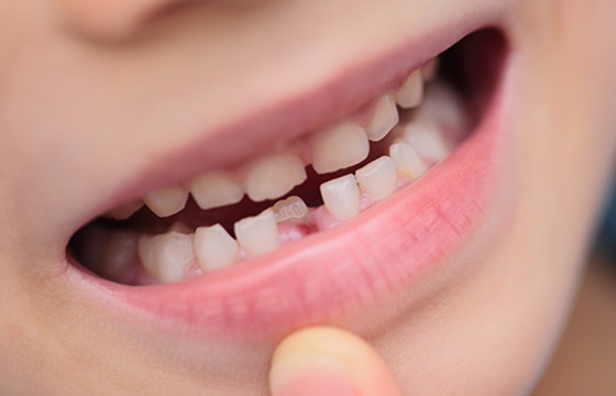 子どもの歯並び矯正はいつから始める？4歳までに歯医者さんへ相談するべき理由