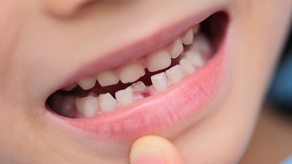 子どもの歯並び矯正はいつから始める？4歳までに歯医者さんへ相談するべき理由