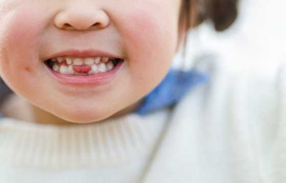 【小児歯科】子どものフッ素塗布はいつから？虫歯ゼロを目指すための「開始時期」と「効果的な頻度」